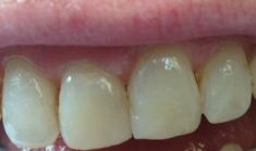 Front teeth after composite fillings
