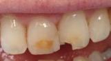 Front teeth before composite fillings